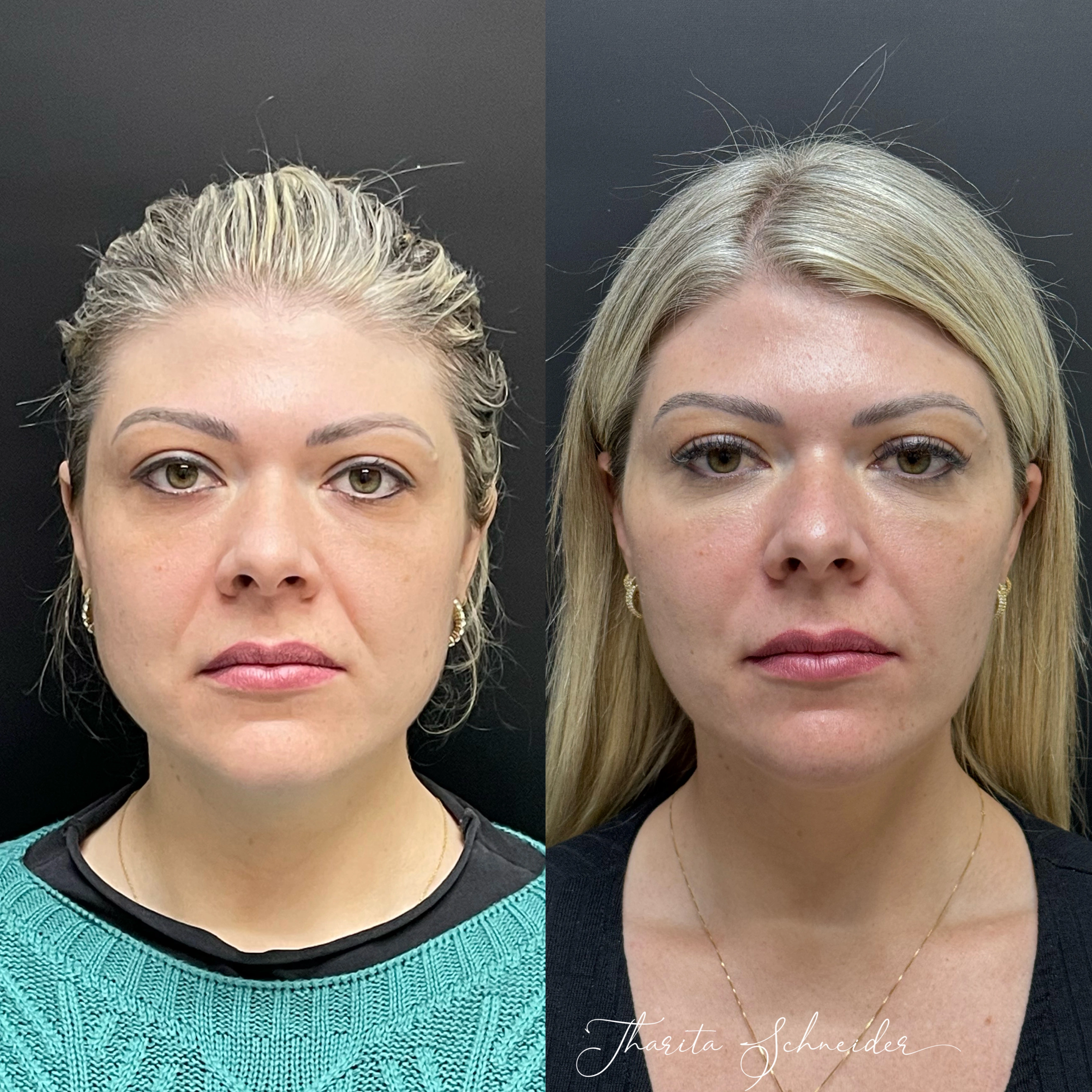 Botox e Preenchimento